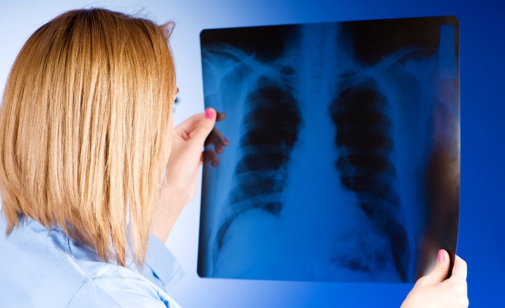 Včasná diagnóza rakoviny plic znamená život. Plicní lékaři proto chystají program plošného skreeningu kuřáků