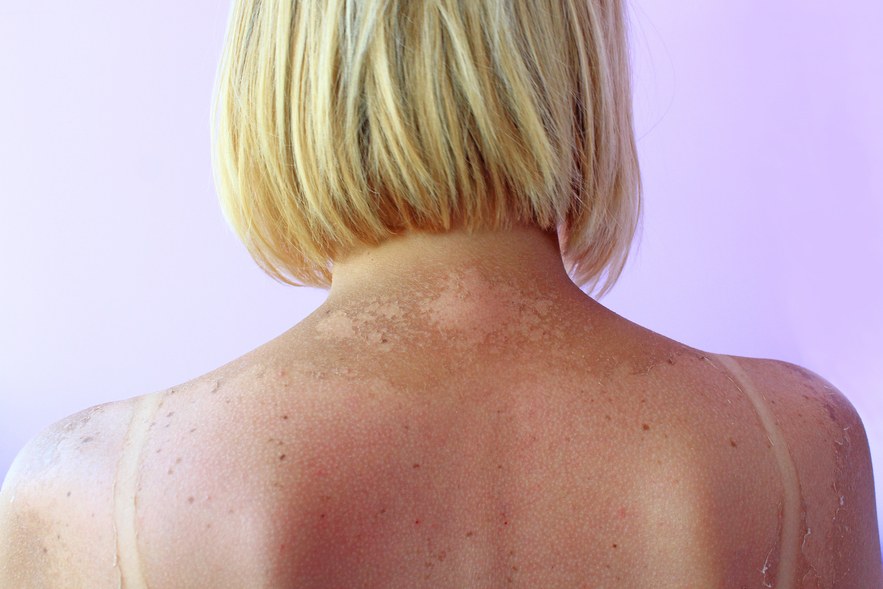 Jak se bránit proti sluneční alergii