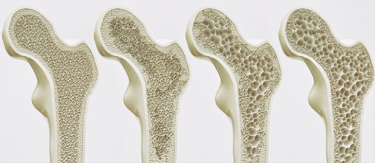 Bojíte se osteoporózy? V průběhu října se můžete nechat zdarma vyšetřit 