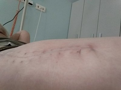 Jizva po 19 dnech od operace